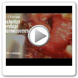 11 Posterior Cervical Microdiscectomy