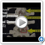 03  Internal Decompression for Spinal Stenosis (IDSS)